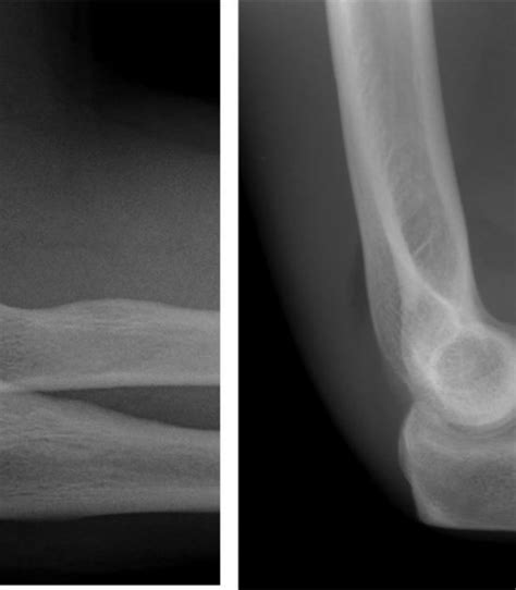 Trauma Elbow X Ray Positioning