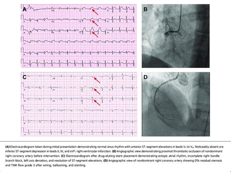 Electrocardiogram And Angiography During An Isolated Right Ventricular