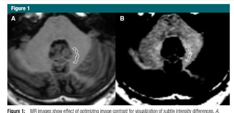 Figure From Signal Enhancement Of The Dentate Nucleus At Unenhanced