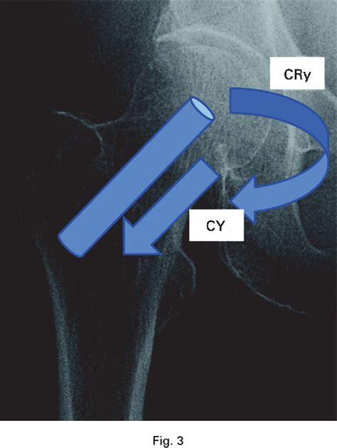 Figure 3 From The Stability Of Fixation Of Proximal Femoral Fractures