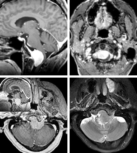 Foramen Magnum Meningioma The Neurosurgical Atlas