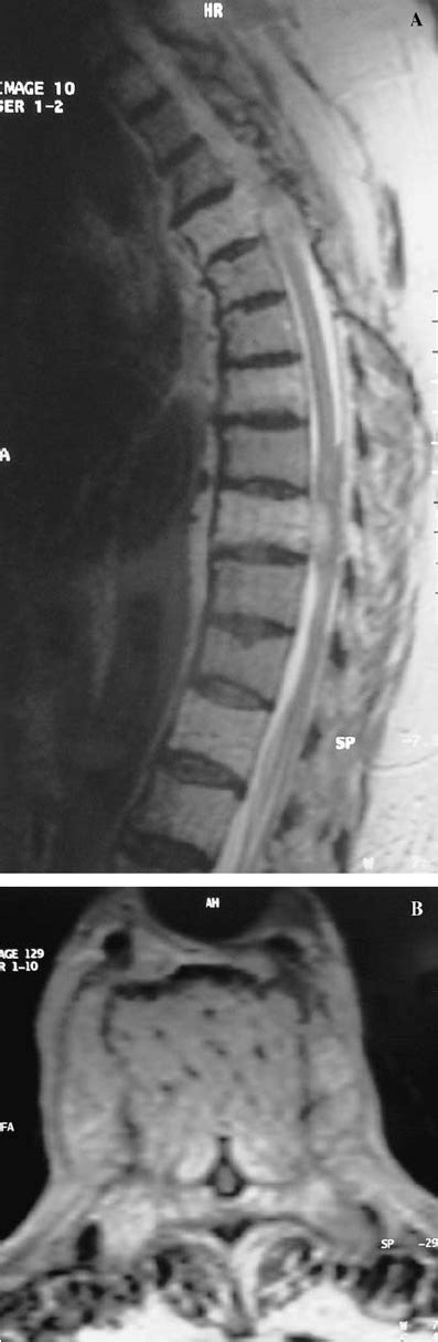 A Sagittal T2 Weighted Magnetic Resonance Image Shows Multiple Thoracic