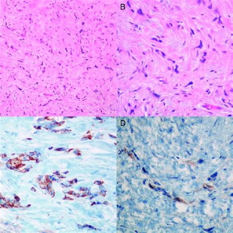 Positive Staining Of Tumor Cells For Calretinin Calretinin 100