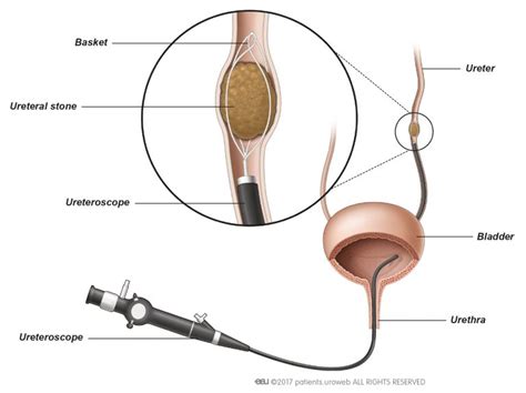 Ureteroscopy Urs Patient Information