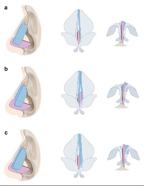 Figure 1 From Centering A Deviated Nose By Caudal Septal Extension