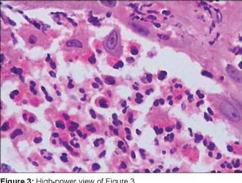 Figure From Pemphigus Vegetans An Unusual Presentation Semantic