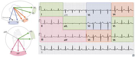 ECG localization of STEMI Diagram | Quizlet