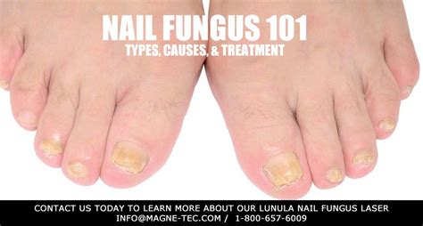 Nail Fungus 101 - Types, Causes, & Treatment - Magne-Tec