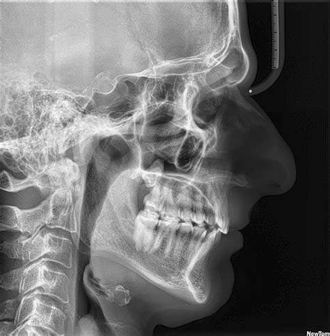 Narrow airway? : r/jawsurgery