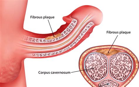 Shockwave Therapy For Peyronies Disease Benefits And Treatment