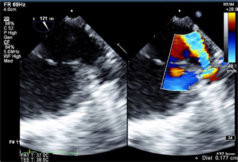 Two Dimensional Transesophageal Echocardiography Midesophageal