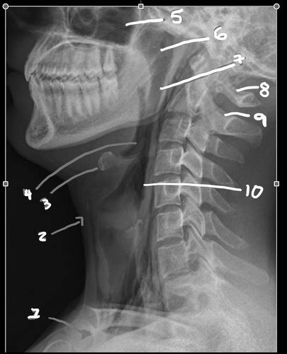 Soft Tissue Neck Flashcards Quizlet