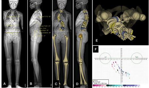 SciELO Brasil BIPLANAR IMAGING WITH TRIDIMENSIONAL CAPABILITIES