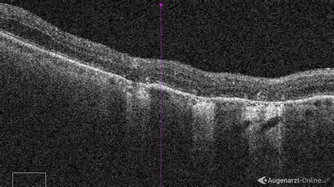 Laserherde ALK Atlas Der Augenheilkunde