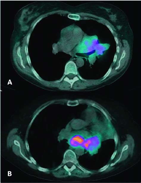 Two Patients With Ga Dotatoc Positron Emission Tomography Ct Images