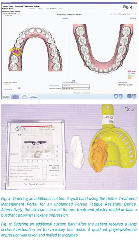 Placing An Unplanned Forsus Fatigue Resistant Device With The Incognito