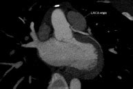 Current Surgical Management Of Anomalous Aortic Origin Of A Coronary