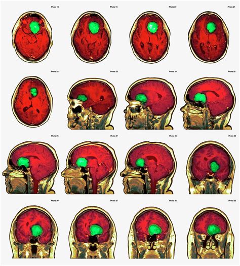 Brain Tumour Photograph By Simon Frasernewcastle Hospitals Nhs Trustscience Photo Library