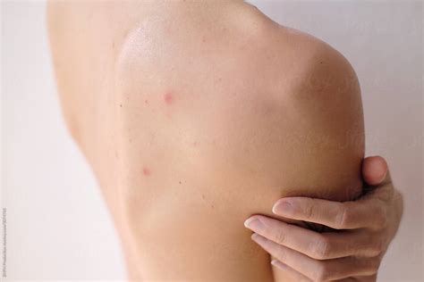 Nude Woman Skin Problems Acne Closeup Shot By Stocksy Contributor