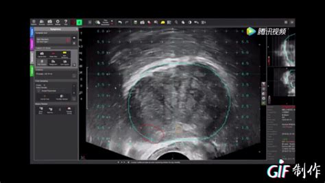 前列腺癌 前列腺磁共振 超声融合精准靶向穿刺