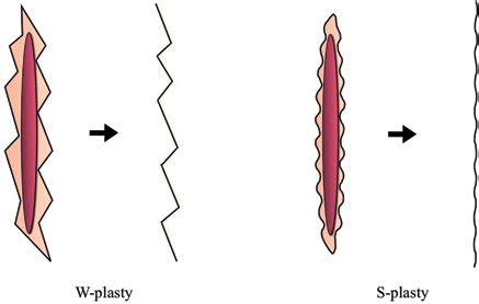 Letter To The Editor S Plasty Method For Secondary Scar Revision After