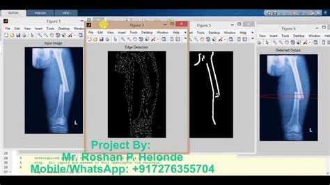 Matlab Code For Bone Fracture Detection Using Image Processing YouTube