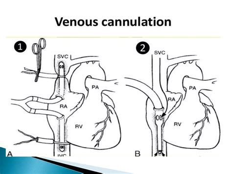 Cannulation And Cardiopulmonary Bypass Ppt