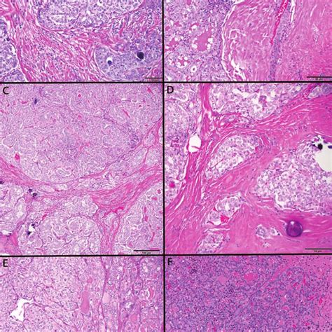 Histologic Patterns Of Sporadic Pediatric Papillary Thyroid Carcinoma