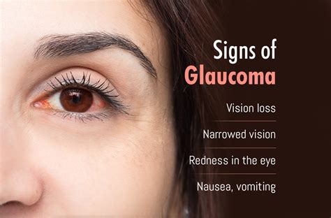 lupus  glaucoma  zara khull blog