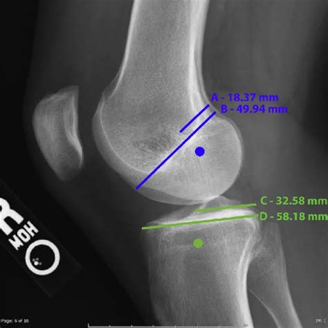 A Lateral View Of The Knee The Origin And Insertion Of The Download Scientific Diagram