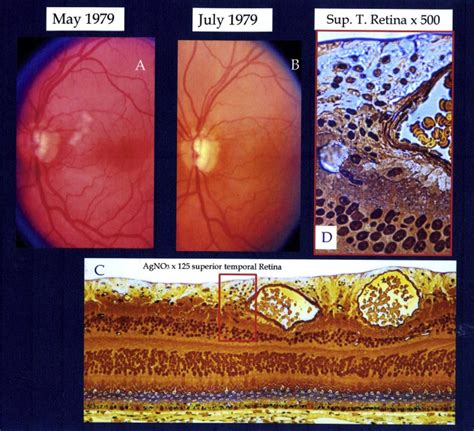 Fundus Photo Os During And After Resolution Of Cotton Wool Spots And Download Scientific