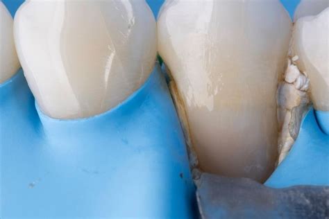 Aesthetic Restoration Of Anterior Teeth Abuladze Dental Center