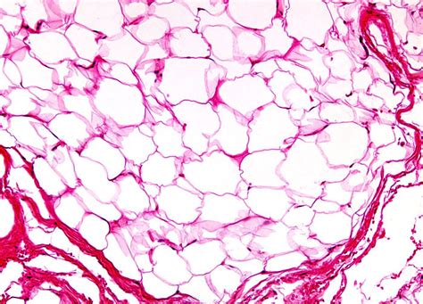 Lipoma Histology