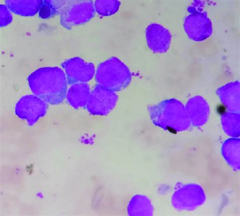 Bone Marrow Aspiration Smear Showing Blasts Cells In A Case Of Aml