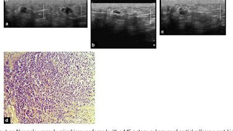 Table From Complex Cystic Breast Masses In Ultrasound Examination