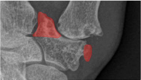 Removal Of The Medial And Lateral Osteophytes At The Distal Articular