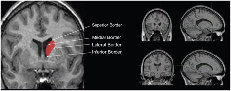 Caudate Nucleus Mri