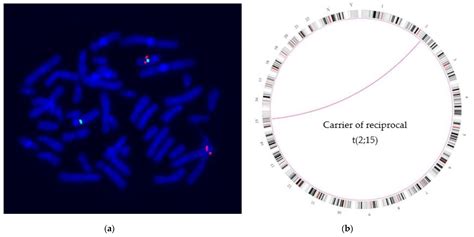 Genes Free Full Text Marfan Syndrome Caused By Disruption Of The Fbn1 Gene Due To A