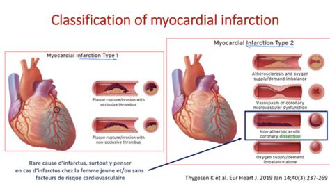 Syndrome Coronarien Aigu Flashcards Quizlet
