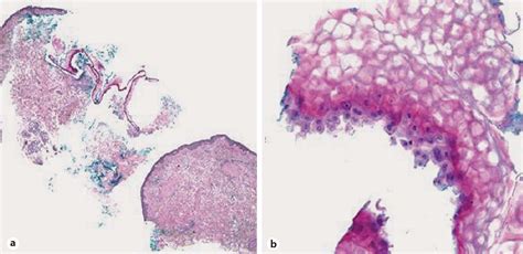 Figure 2 From Staphylococcal Scalded Skin Syndrome In An Adult On