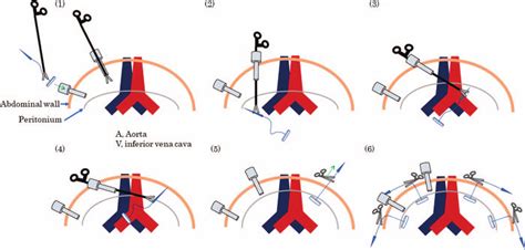 Schematic Illustrations Of Peritoneal Traction Using The Laptraction