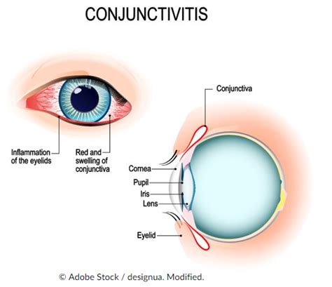 Neonatal Conjuctivitis