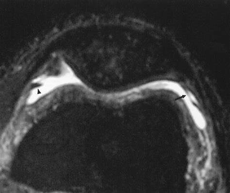 Synovial Plicae In The Knee Ajr