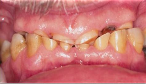 Determinants Of Occlusal Morphology Flashcards Quizlet