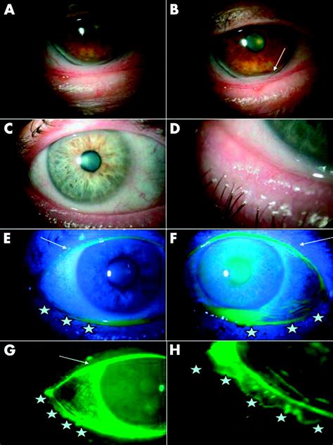 Clinical Characteristics Of Conjunctivochalasis With Or Without Aqueous