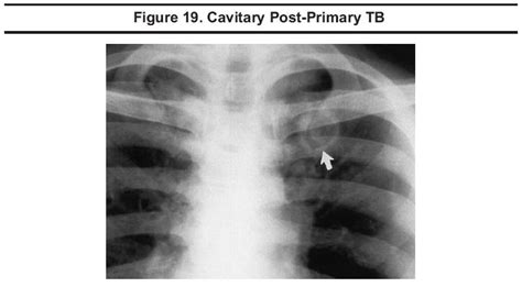 Apical Pleural Thickening Tb