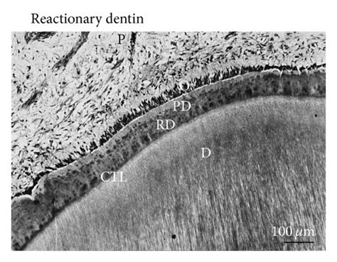 Reparative and reactionary dentin formation. After filling a cavity...