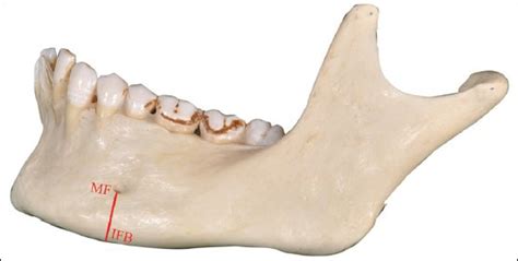 Inferior Border Of Mandible