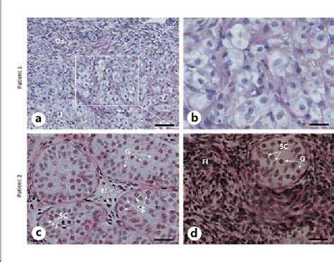 Figure 2 From A Case Of Two Sisters Suffering From 46xy Gonadal