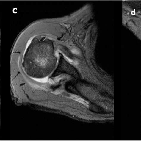 Greater tuberosity fracture. a Posteromedially displaced GT fracture ...